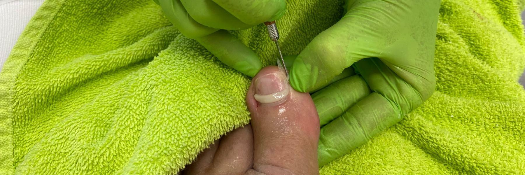 Fußbehandlung mit Nagelvlies